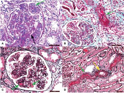 Thrombotic microangiopathy mediates poor prognosis among lupus nephritis via complement lectin and alternative pathway activation